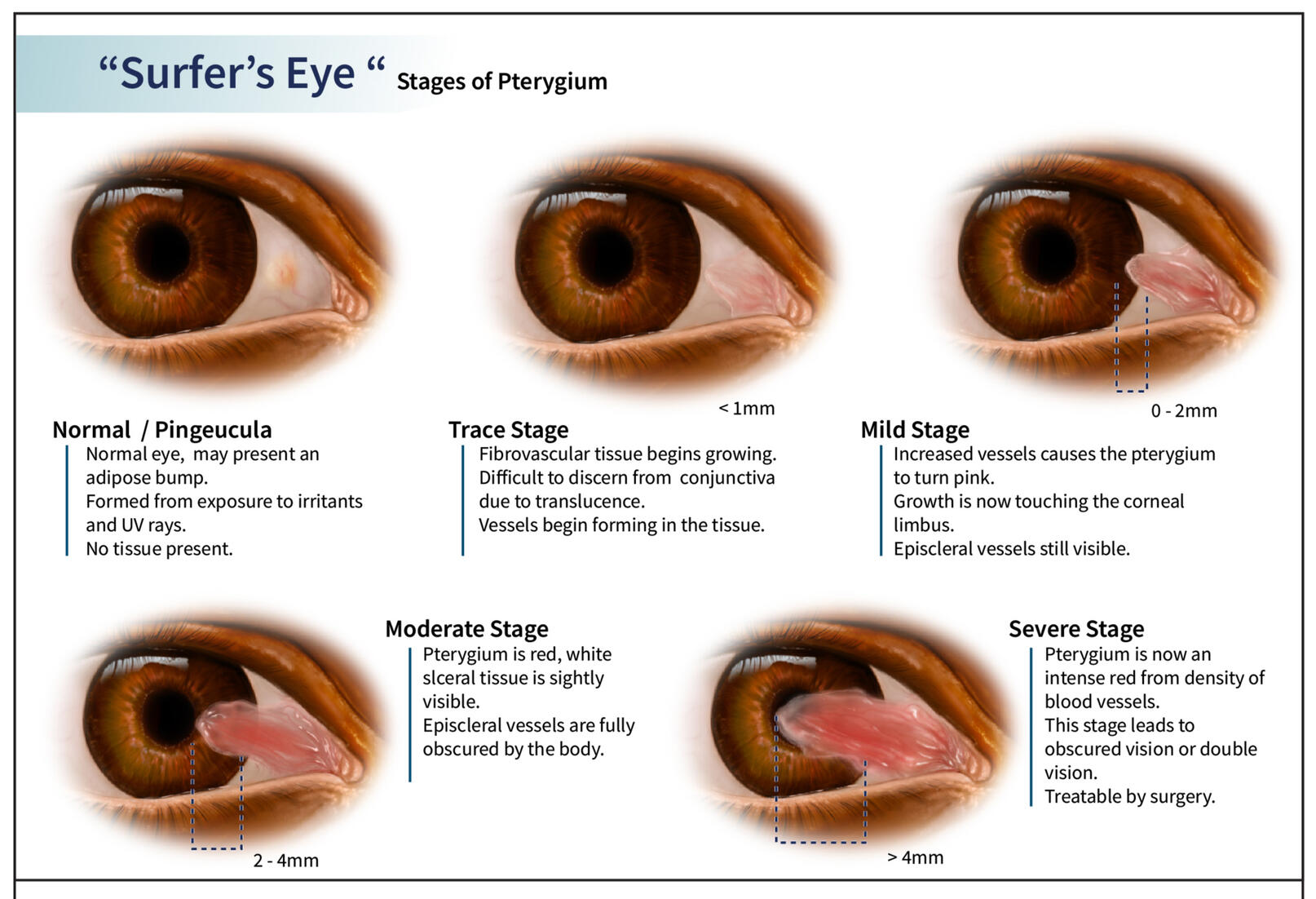 Surfer&#39;s eye editorial, created in Procreate, Adobe Photoshop and Illustrator