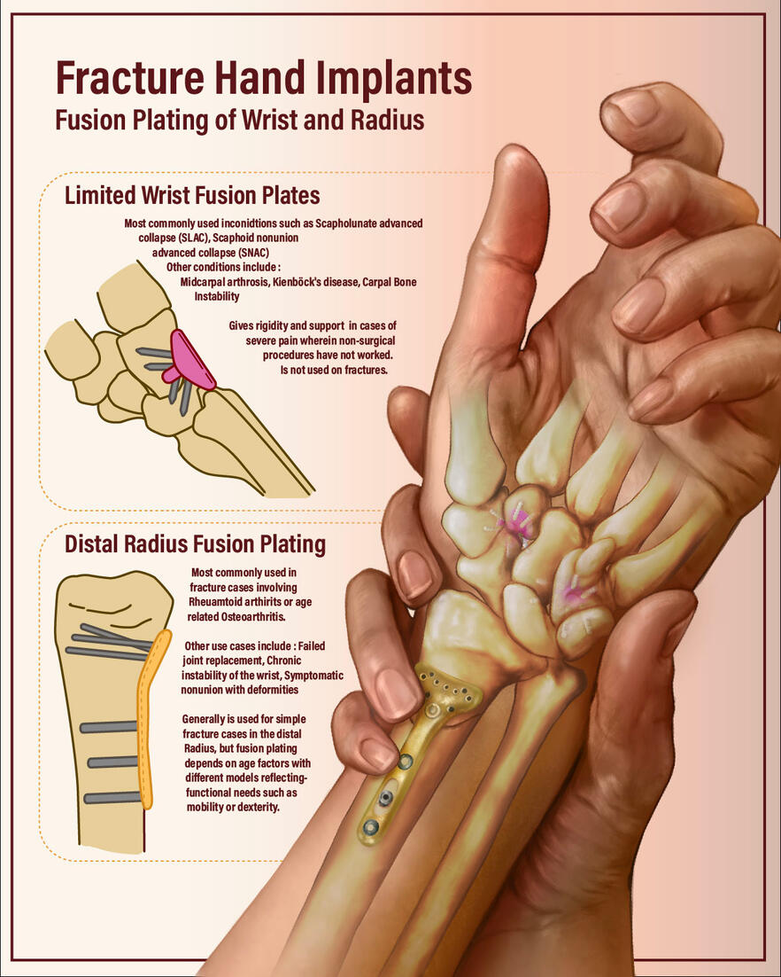 Hand implants transview : Created in Photoshop (2024 &amp; Beta), Adobe Illustrator, 3d Viewer, Substance Painter, Blender